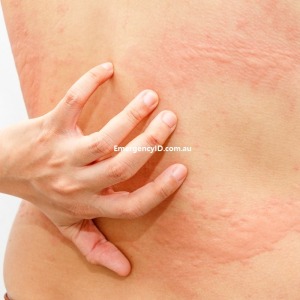 Anaphylaxis allergy reaction body rash Emergency ID allergy alerts